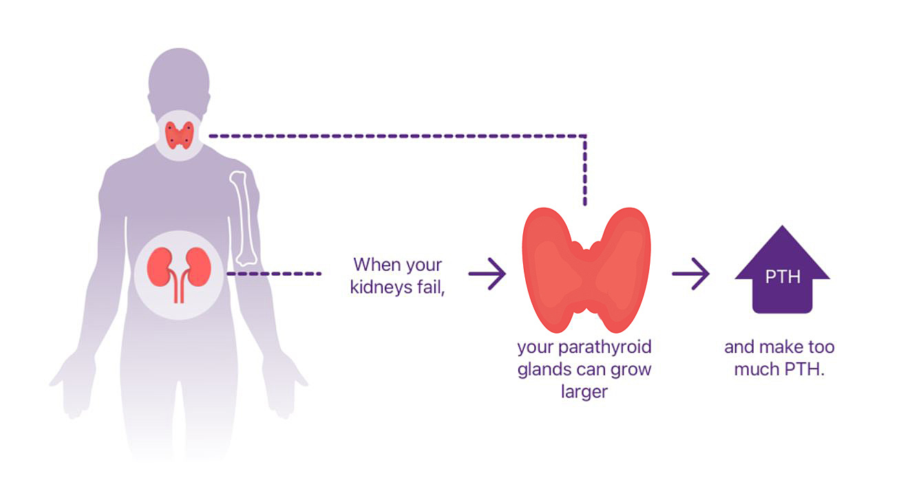 Diagram Showing What Causes sHPT